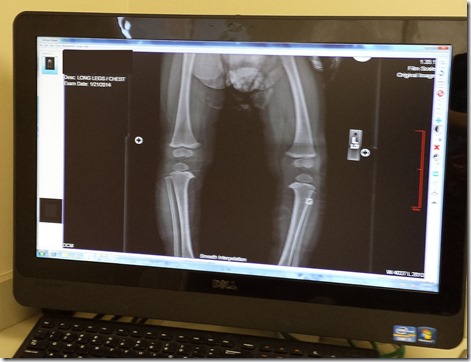 Silje's leg X-rays